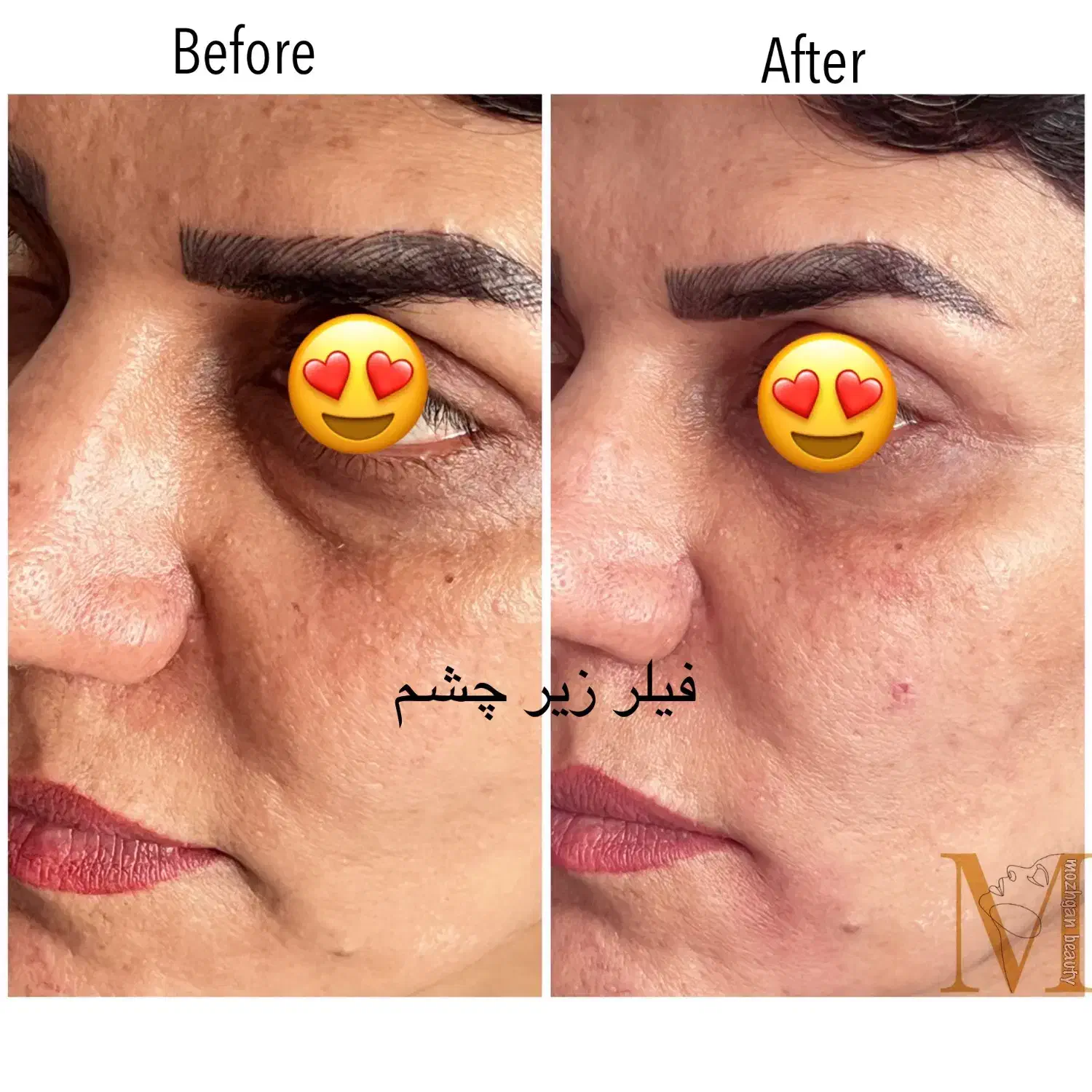 تزریق و آموزش بوتاکس و ژل و پرسینگ و مزو و غیره|خدمات آرایشگری و زیبایی|شیراز, نصر|دیوار