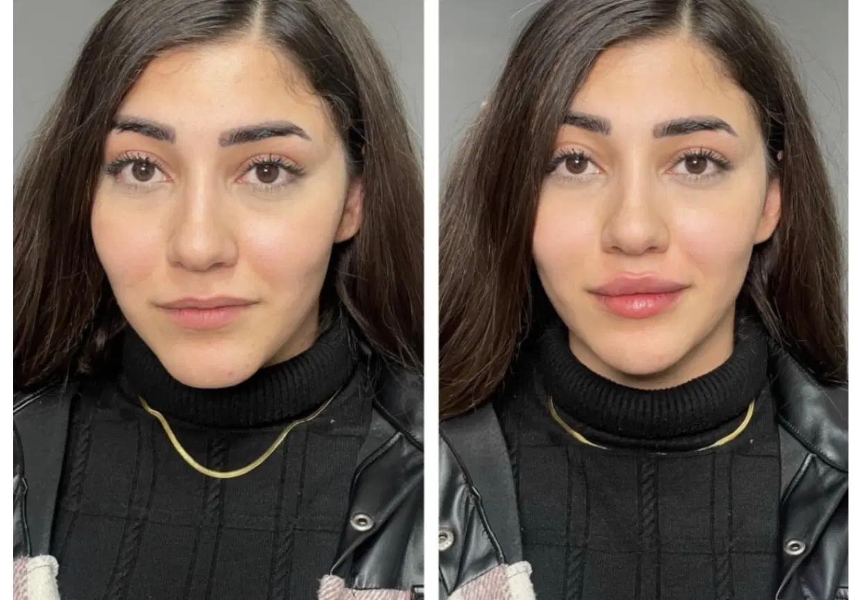 تزریق تخصصی ژل بادی فیلر بوتاکس مزو ژل لب|خدمات زیبایی و سلامت|تهران, صادقیه|دیوار