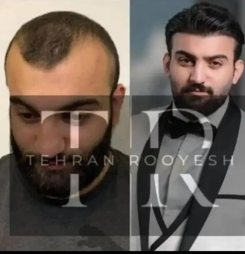 جشنواره یلدایی کاشت مو در تهران یک روزه|خدمات آرایشگری و زیبایی|تهران, جماران (نیاوران)|دیوار