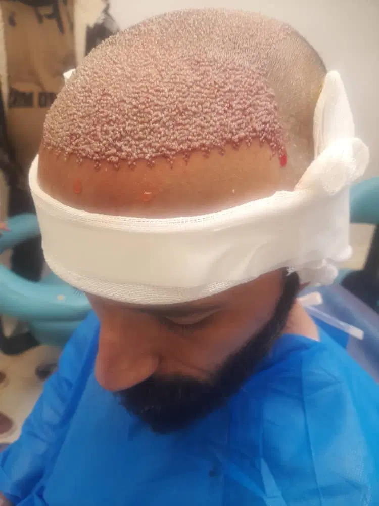 کاشت ریش و مو وابرو طبیعی مشاوره رایگان|خدمات زیبایی و سلامت|کرج, شهرک طالقانی|دیوار