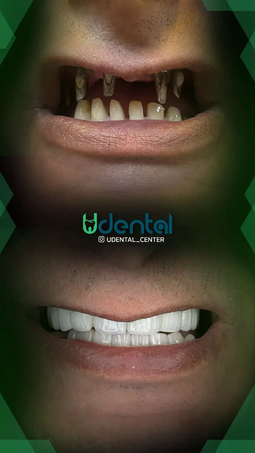 کاشت لبخند / کامپوزیت لمینیت|خدمات آرایشگری و زیبایی|تهران, قبا|دیوار