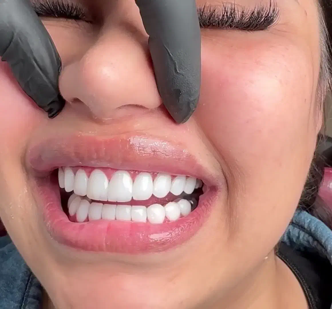 کامپوزیت دندان|خدمات آرایشگری و زیبایی|بوشهر, |دیوار