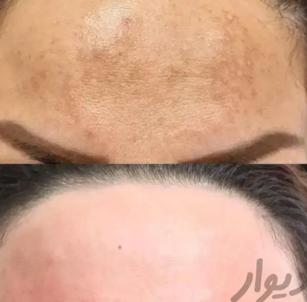 حذف تاتو با لیزر کیوسوئیچ و روشن کننده بیکینی صورت|خدمات آرایشگری و زیبایی|ارومیه, |دیوار