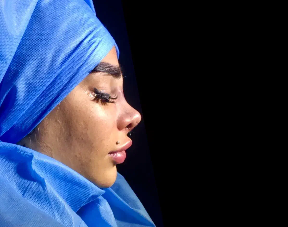 تیپ پلاستی ۱۶ بدون بیهوشی|خدمات آرایشگری و زیبایی|تهران, آسمان|دیوار