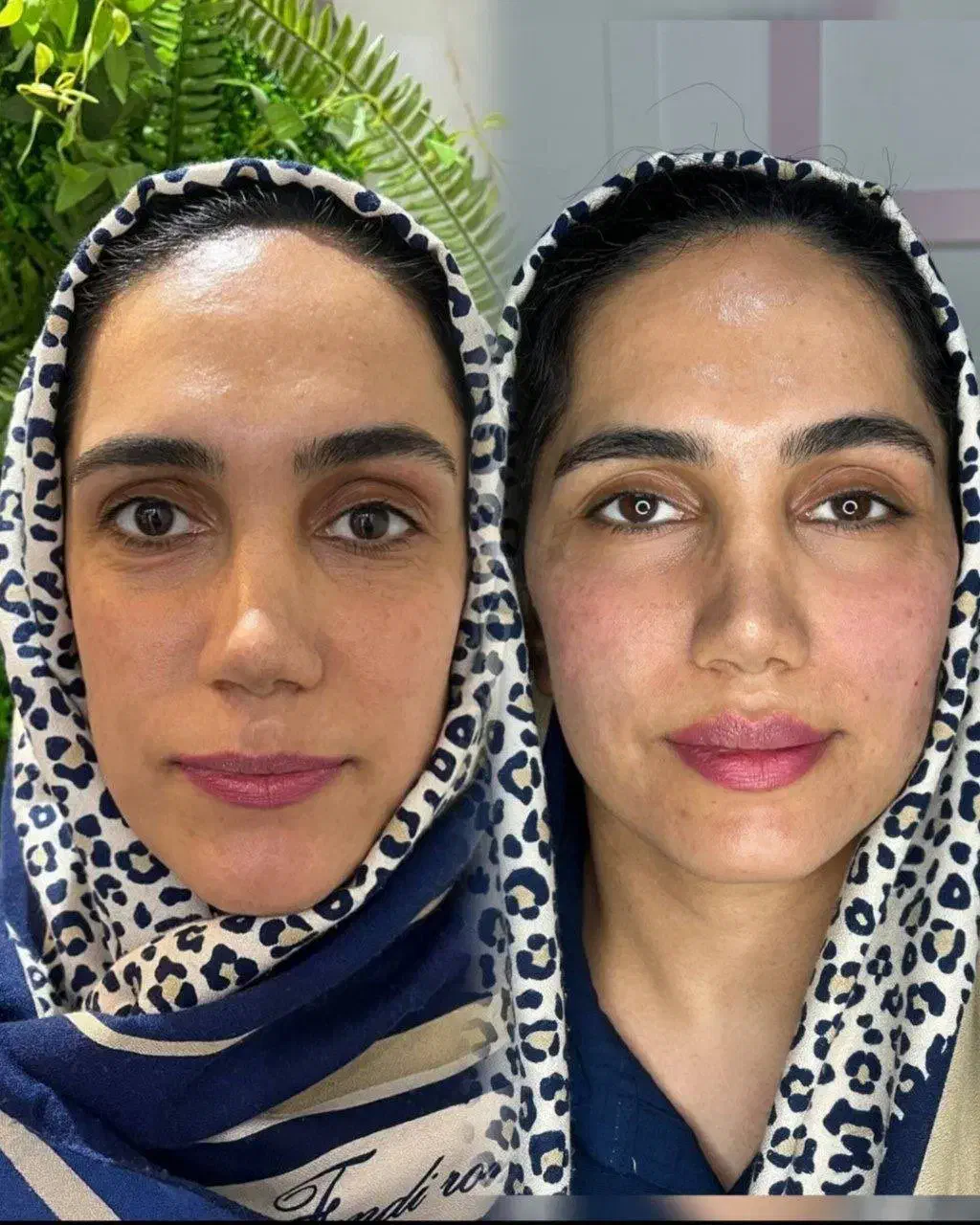 جشنواره تزریق ژل و لیفت صورت|خدمات آرایشگری و زیبایی|قم, زنبیل آباد|دیوار