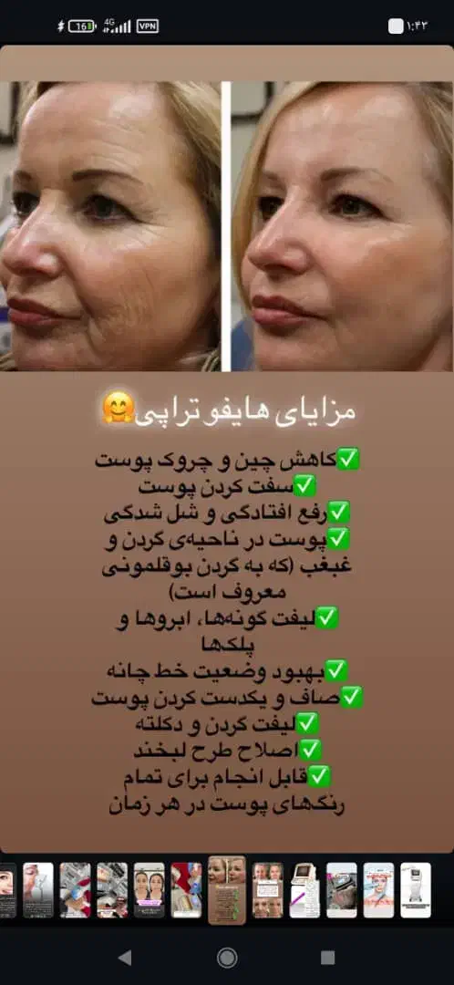 هایفوتراپی ۷بعدی تخفیف ویژه برای اولین ها|خدمات آرایشگری و زیبایی|قم, صدوق|دیوار