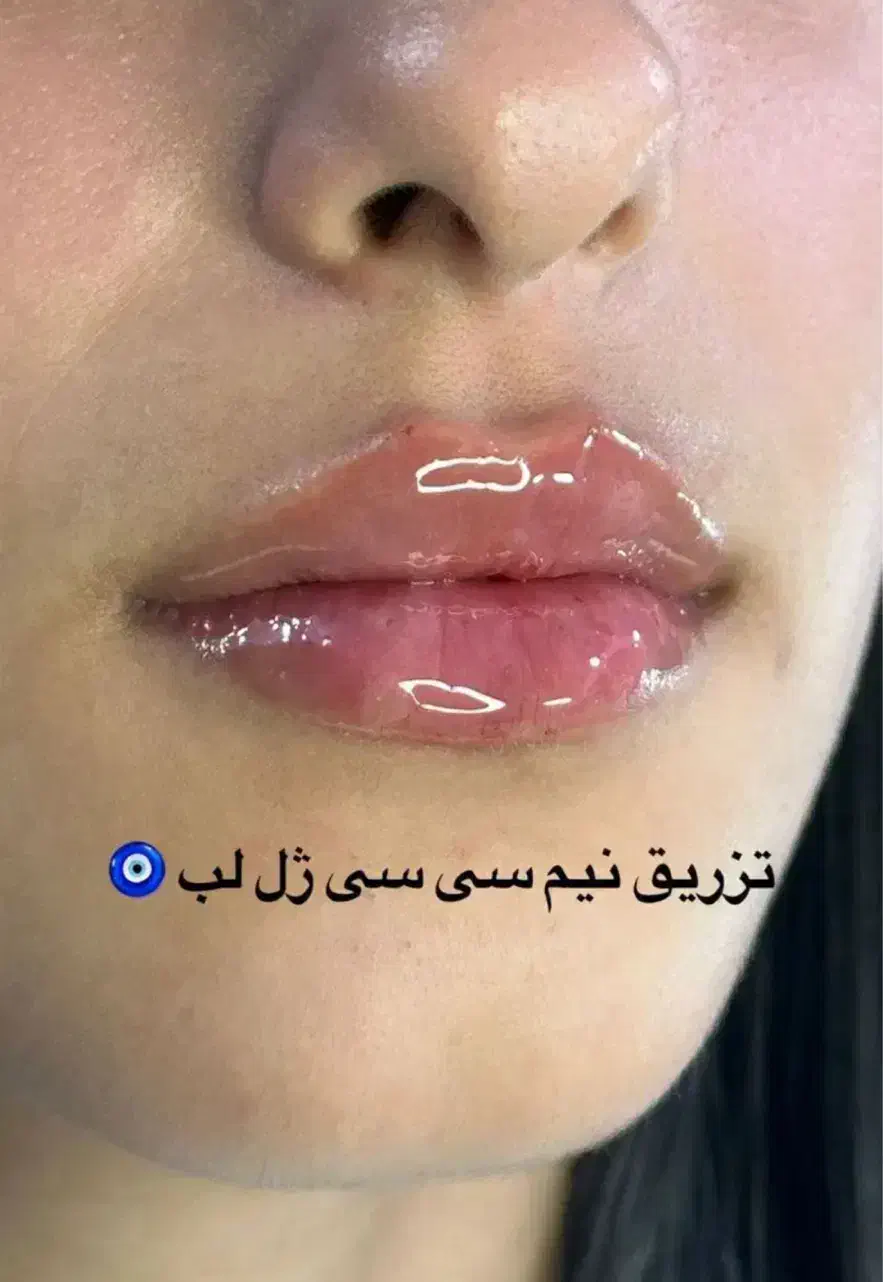 مدل ژل /فیلر /بوتاکس|خدمات آرایشگری و زیبایی|باقرشهر, |دیوار