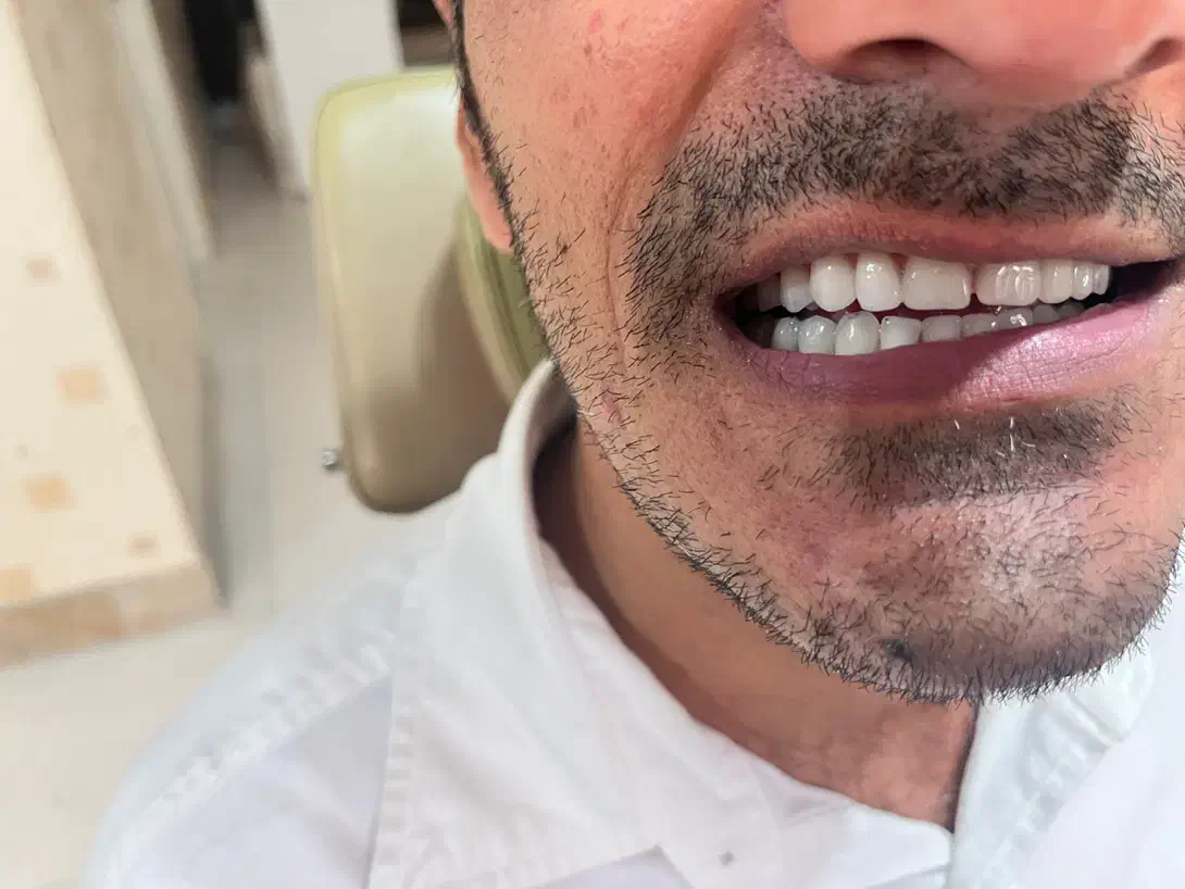 دندانسازی دندان مصنوعی|خدمات آرایشگری و زیبایی|مشهد, هفت تیر (آب و برق)|دیوار