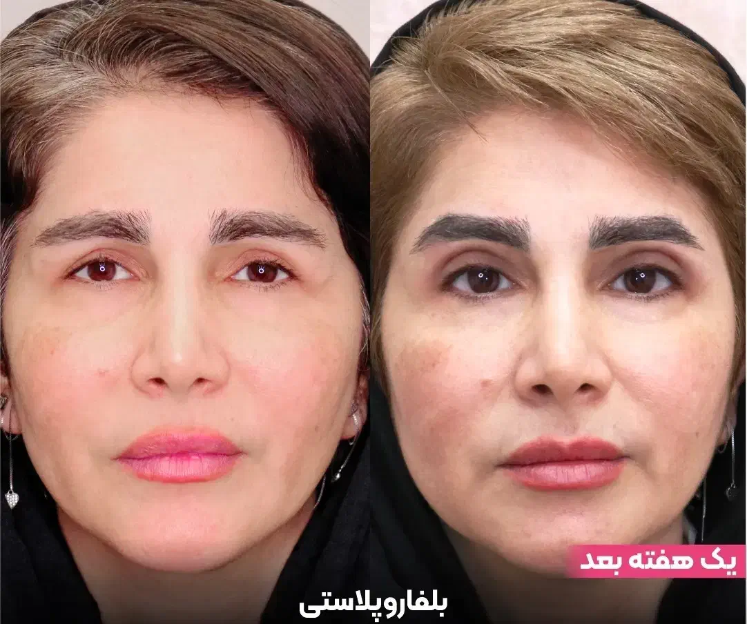 لیپو/ابدو/بلفارو/کاشت/ قسطی در تهران|خدمات آرایشگری و زیبایی|زاهدان, |دیوار