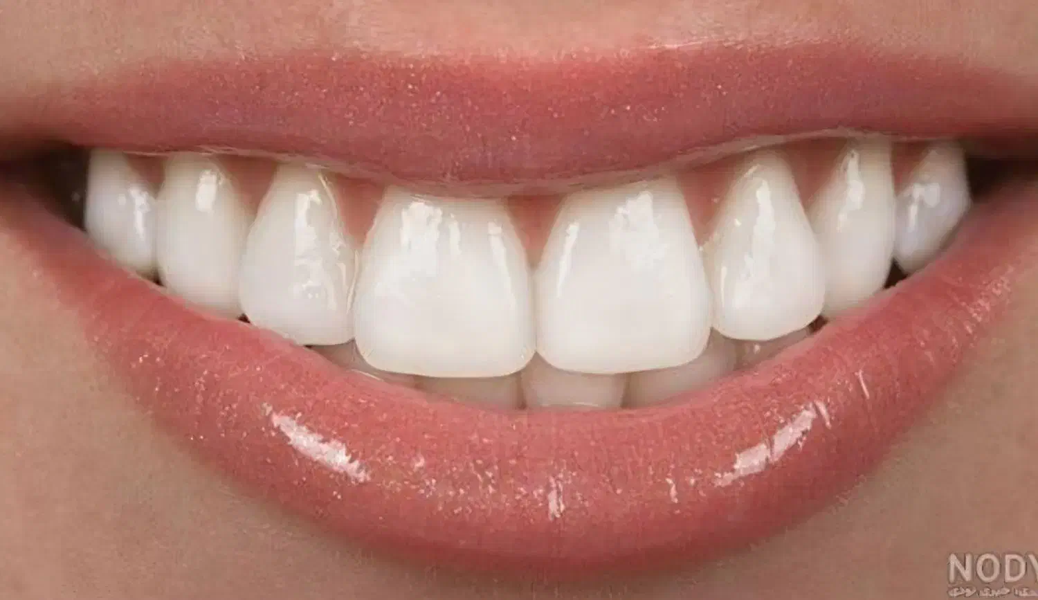 کامپوزیت بدون تراش دندان فکی ۶میلیون|خدمات آرایشگری و زیبایی|قم, شهرک مهدیه|دیوار