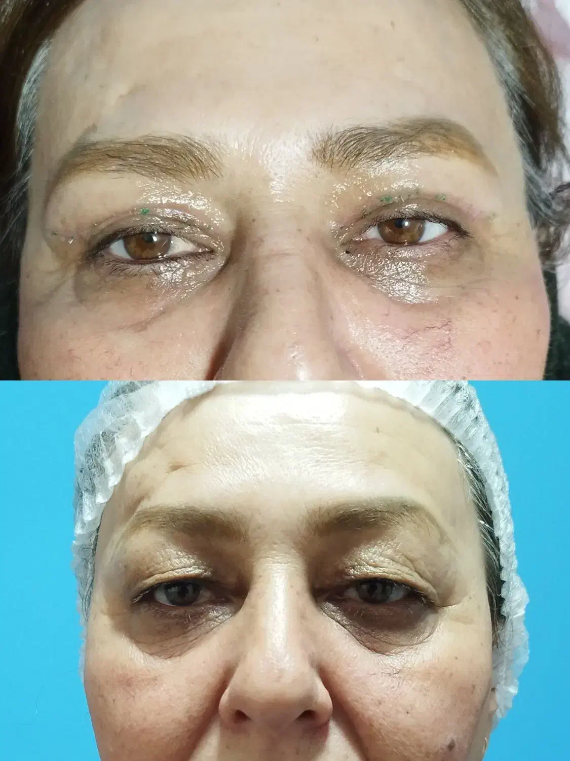 بلفاروپلاستی پلک بالا به مدت محدود فقط 8 میلیون|خدمات آرایشگری و زیبایی|بوکان, |دیوار