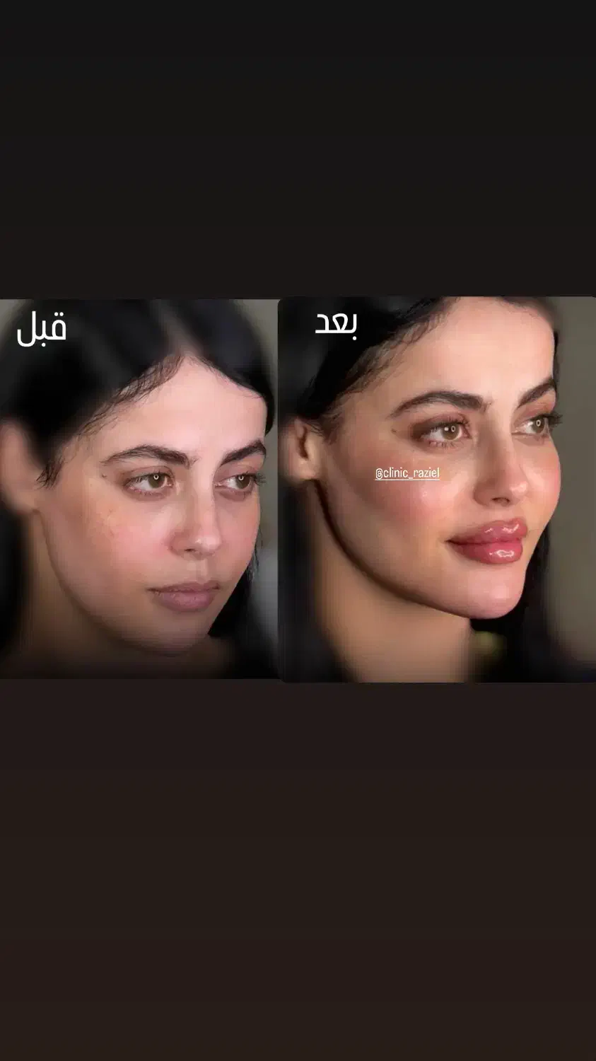 تخفیفات استثنایی ژل و بوتاکس در مطب زیبایی|خدمات آرایشگری و زیبایی|قم, دورشهر|دیوار