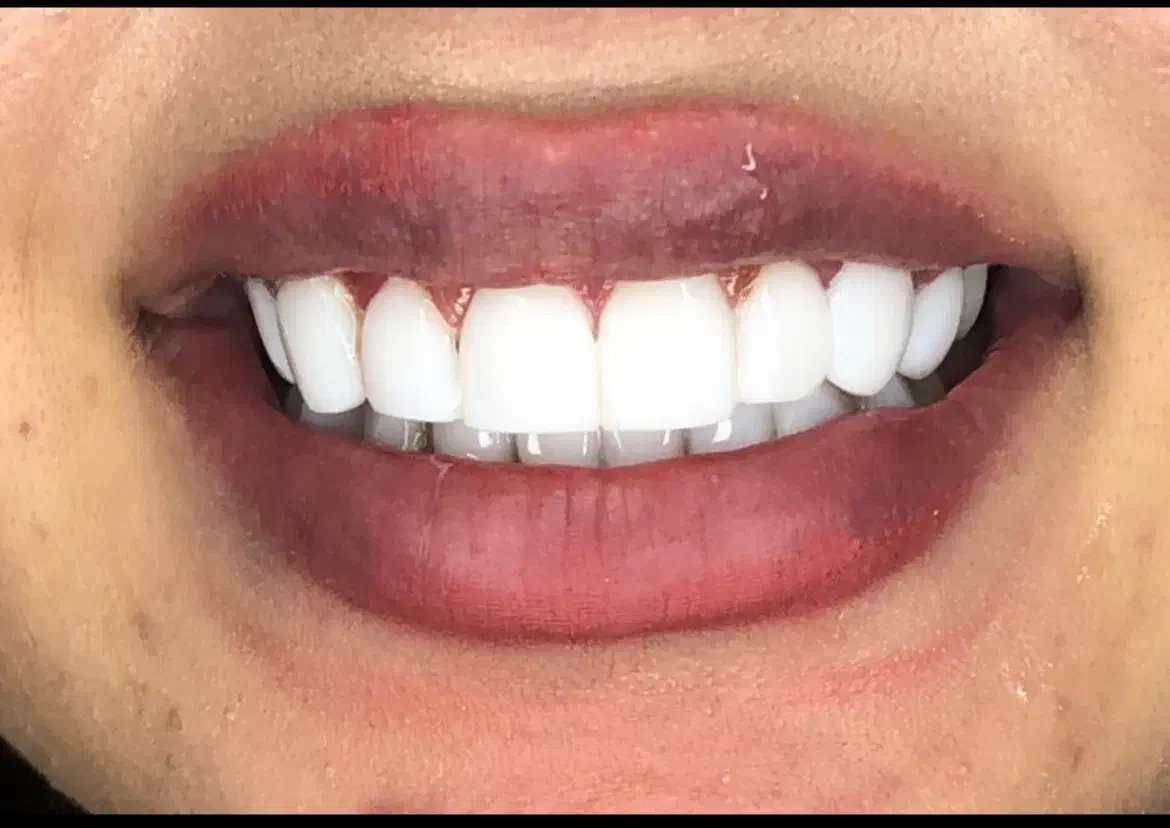 کامپوزیت دندان جشنواره|خدمات آرایشگری و زیبایی|تهران, فردوسی|دیوار