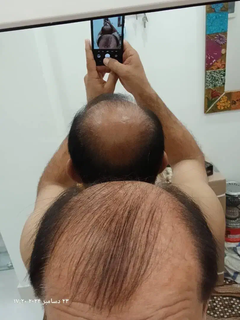 کاشت مو طبیعی در بوشهر وشیراز|خدمات آرایشگری و زیبایی|بوشهر, |دیوار