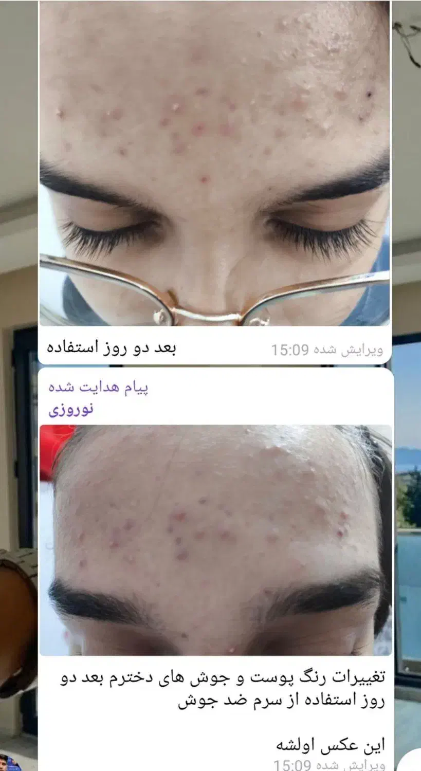 مشکلات پوستیی پسوریازیس لک و...تضمینی|آرایشی، بهداشتی، درمانی|اردبیل, |دیوار