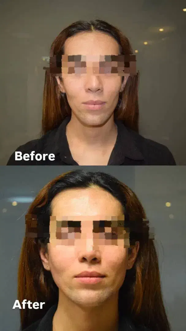 متقاضی مدل فیلر بوتاکس لیفت نخ|خدمات آرایشگری و زیبایی|تهران, دروس|دیوار