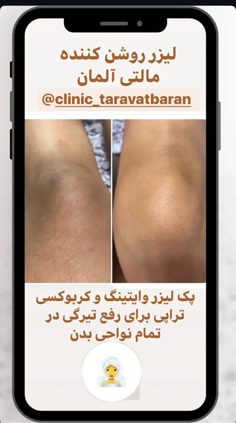 لیزر موهای زائد پی‌آر‌پی هایفو حجم‌سینه‌باسن لاغری|خدمات آرایشگری و زیبایی|تهران, صادقیه|دیوار