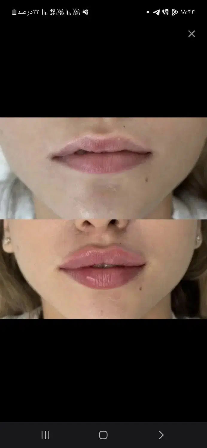 تزریق ژل|خدمات آرایشگری و زیبایی|پاکدشت, پاکدشت (مامازند)|دیوار