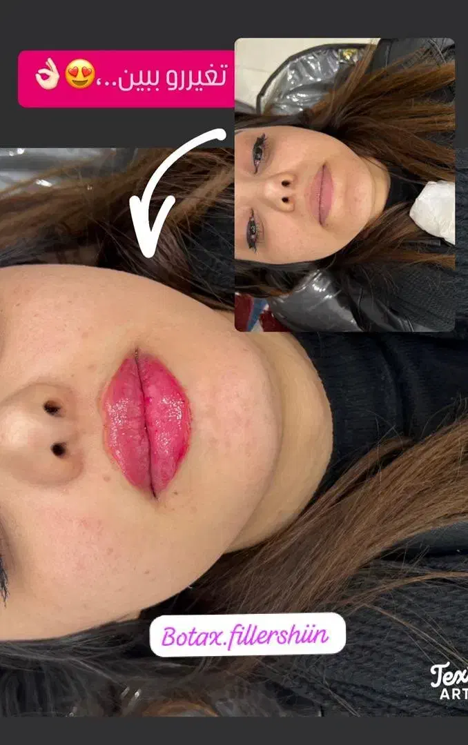 مادلینگ صورت( ژل و بوتاکس)|خدمات آرایشگری و زیبایی|زرقان, |دیوار