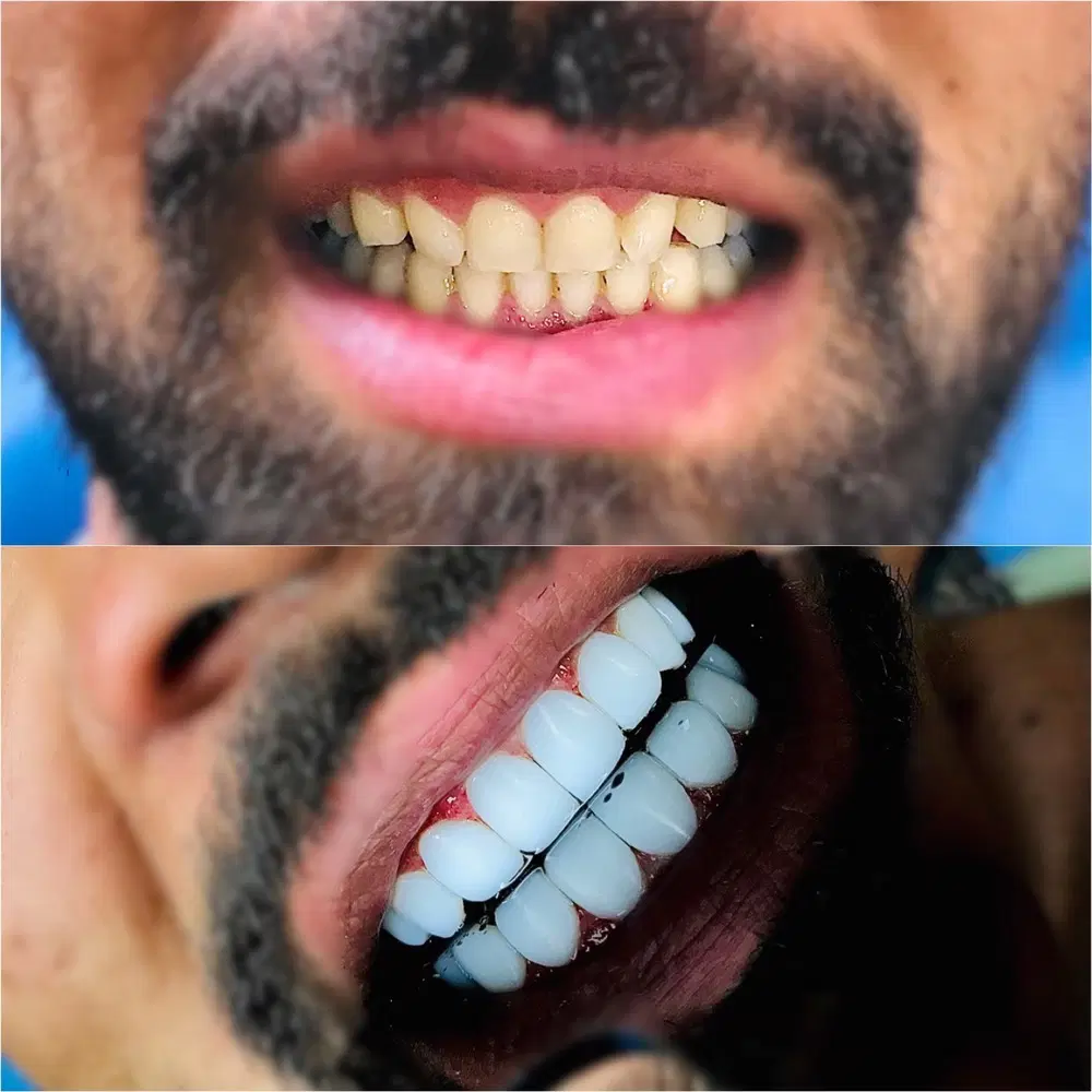 جشنواره تخفیف کامپوزیت دندان / مواد درجه یک|خدمات زیبایی و سلامت|کرج, کرج نو|دیوار