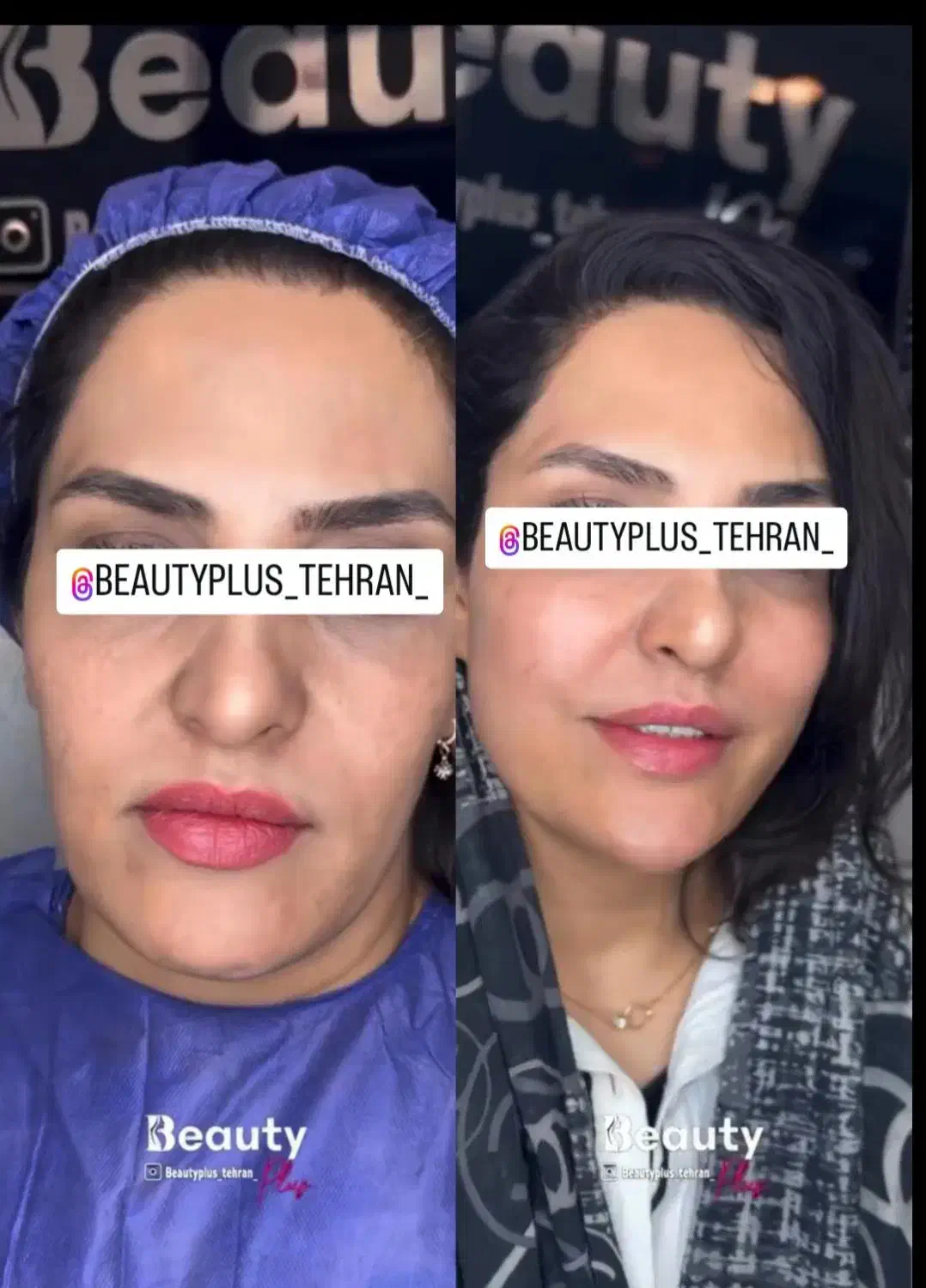 ساکشن غبغب وتزریق چربی بصورت و هرناحیه ازبدن درمطب|خدمات آرایشگری و زیبایی|قم, زنبیل آباد|دیوار