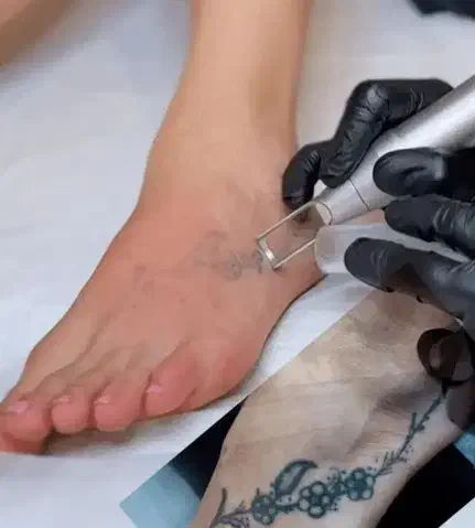 ریموو تتو های قدیمی بدن با دستگاه لیزر کیوسوییچ|خدمات آرایشگری و زیبایی|اردبیل, |دیوار