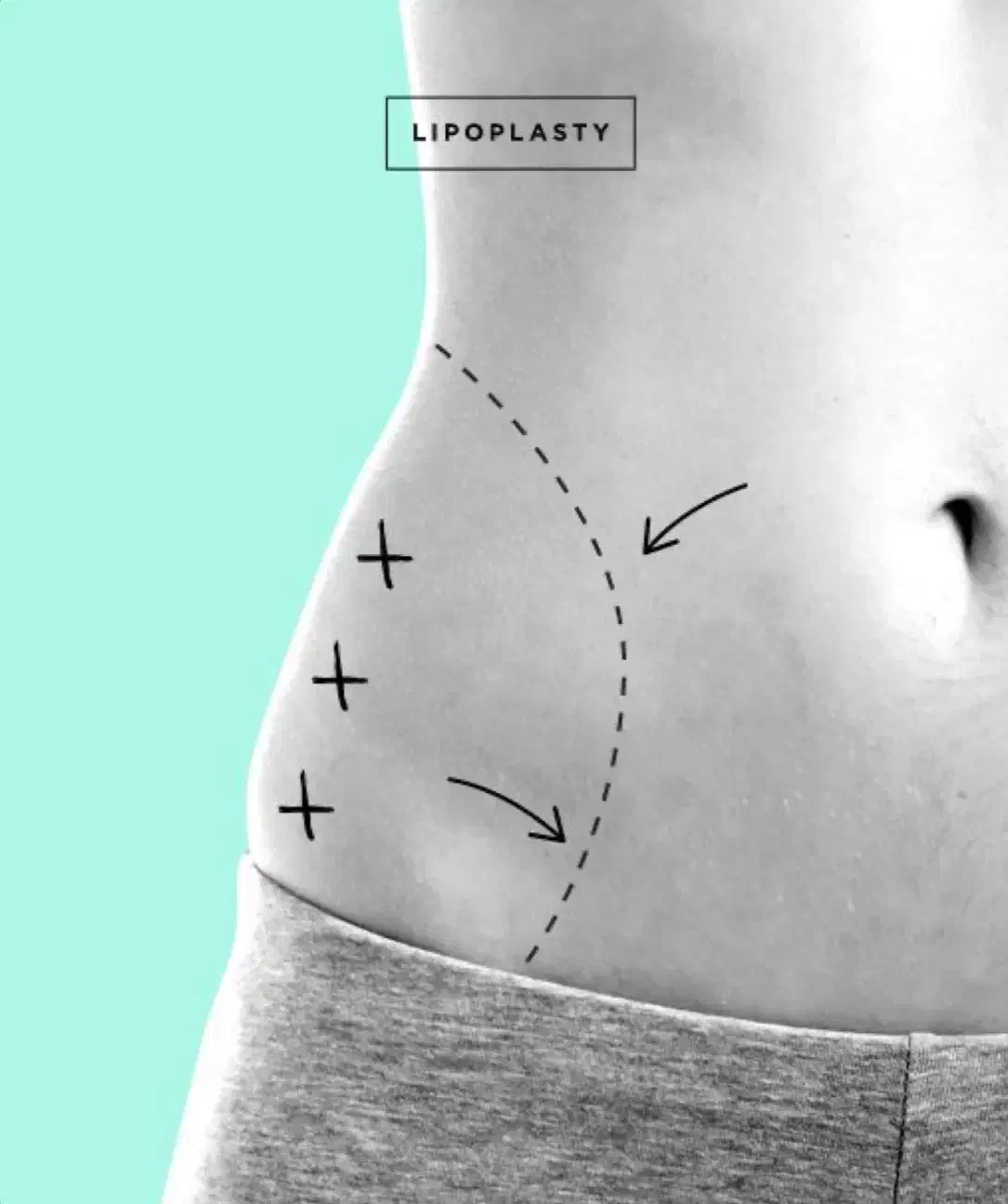 لیپو وابدو فرم دهی شکم و پهلو توسط متخصص با تخفیف|خدمات آرایشگری و زیبایی|کرج, مهرویلا جنوبی|دیوار