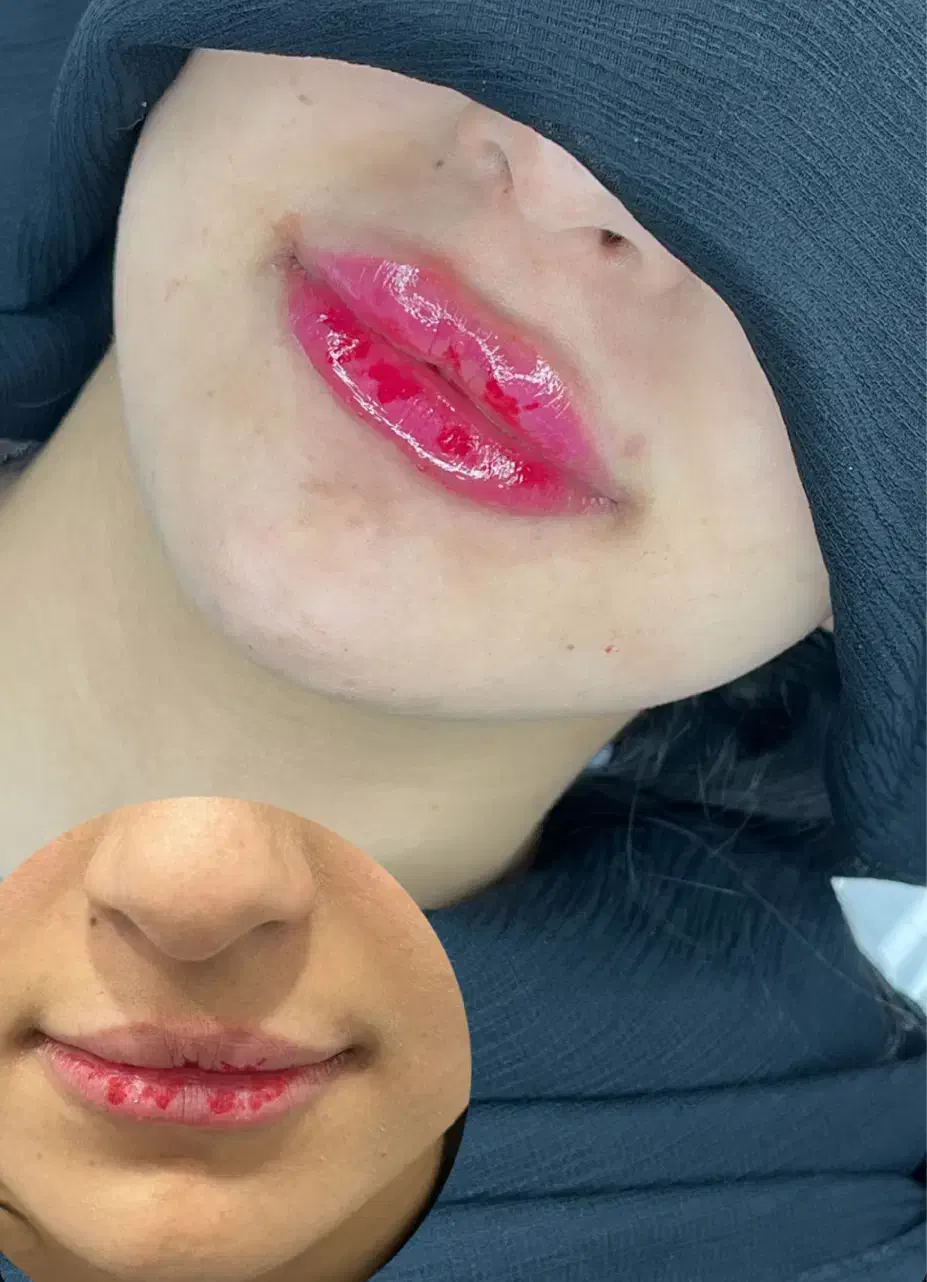 ژل و بوتاکس|خدمات آرایشگری و زیبایی|شوشتر, |دیوار