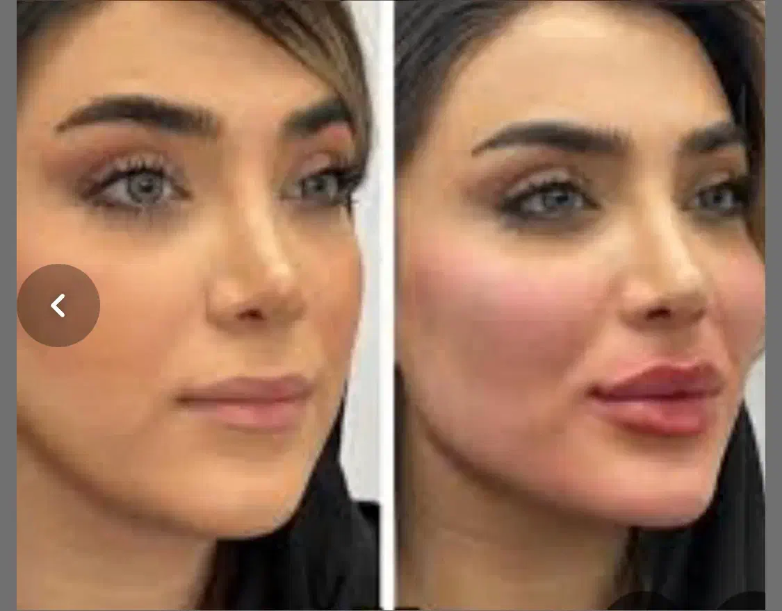 تزریق چربی ،ساکشن غبغب،پی ارپی مو ،مزو زگیل میخچه|خدمات آرایشگری و زیبایی|یاسوج, |دیوار