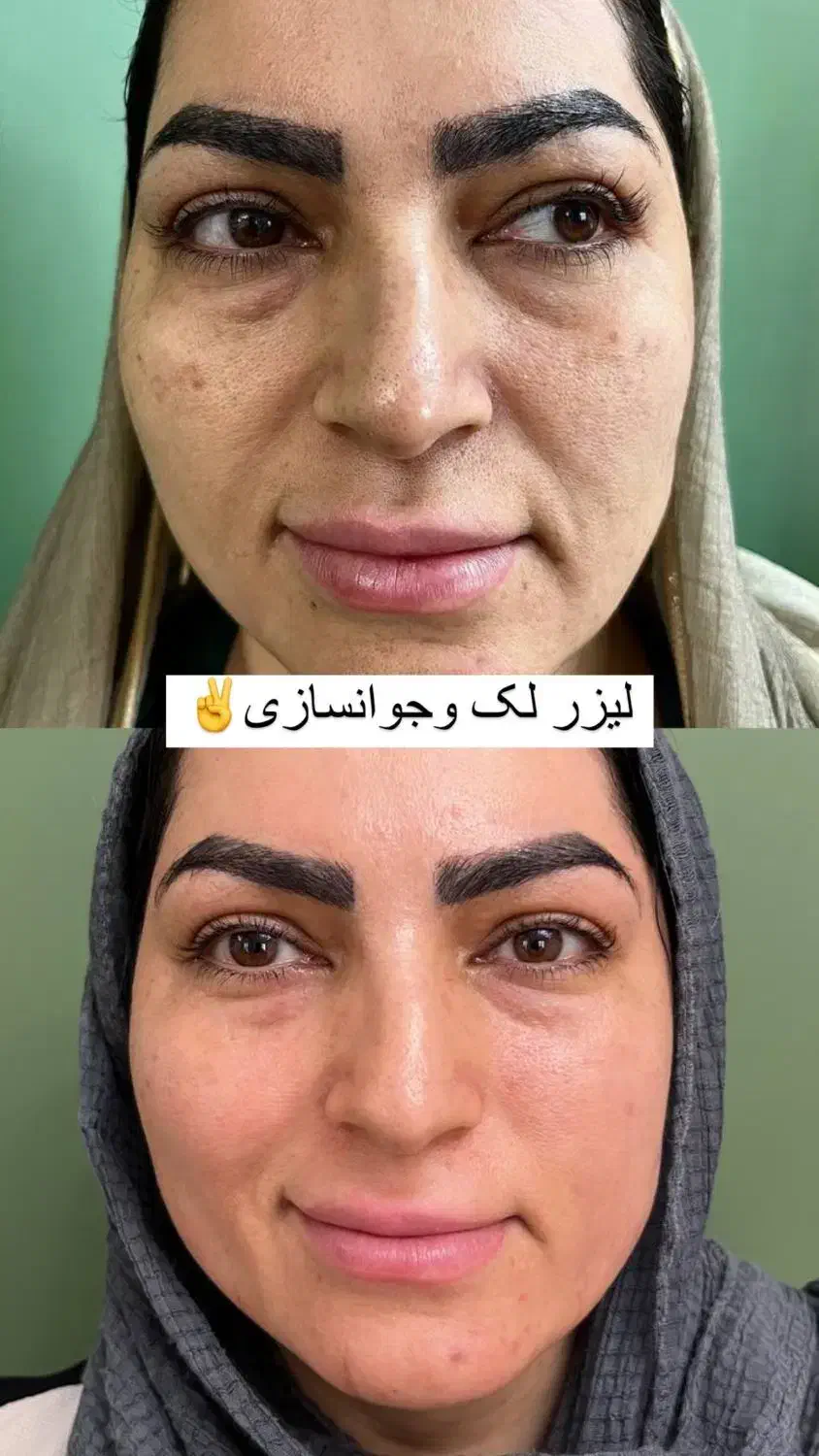 لیزرco2ترکیبی تک جلسه ای هموارساز اف ویژه|خدمات آرایشگری و زیبایی|دوگنبدان, |دیوار