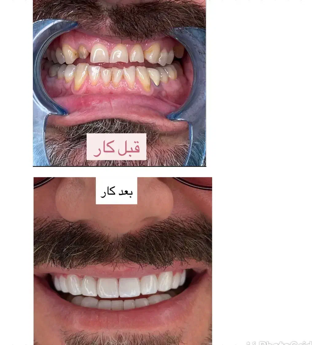 کامپوزیت ونیر آلمانی|خدمات آرایشگری و زیبایی|تهران, چیذر|دیوار