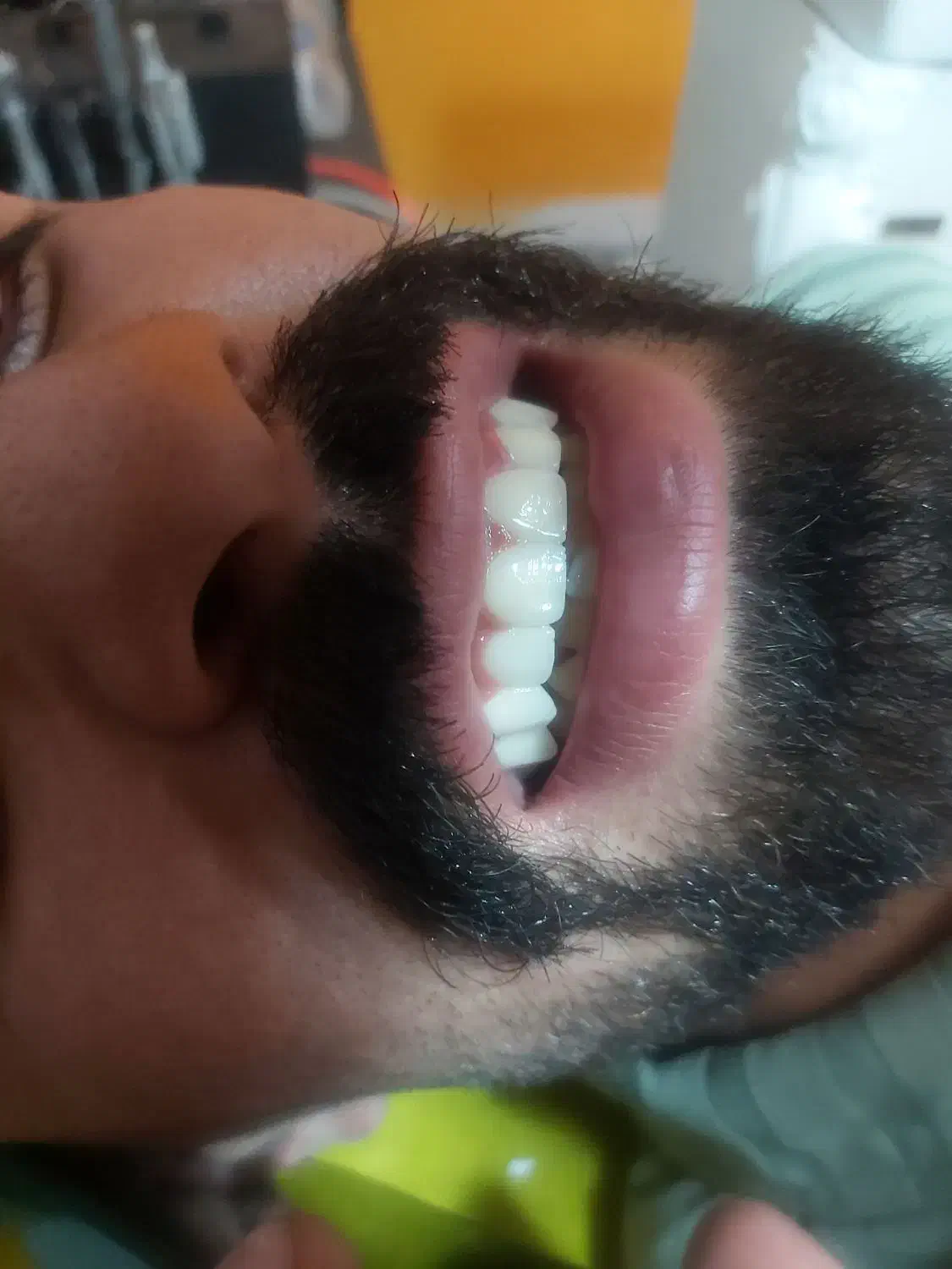 عصبکشی پر کردن ۱۳۰۰ روکش فروش رادیوگرافی|خدمات آرایشگری و زیبایی|مرند, |دیوار