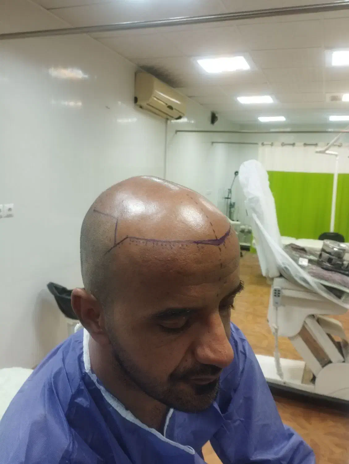 کشت مو ب روش fit|خدمات آرایشگری و زیبایی|کرمان, |دیوار