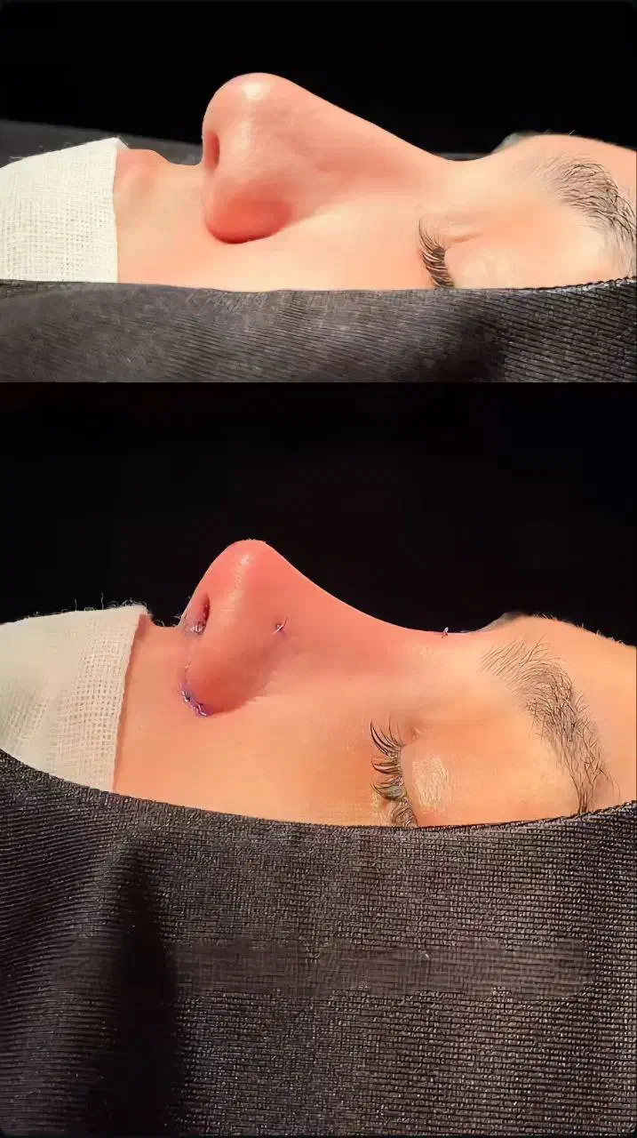 جشنواره عمل بینی به سبک جراحان ترکیه|خدمات آرایشگری و زیبایی|لامرد, |دیوار