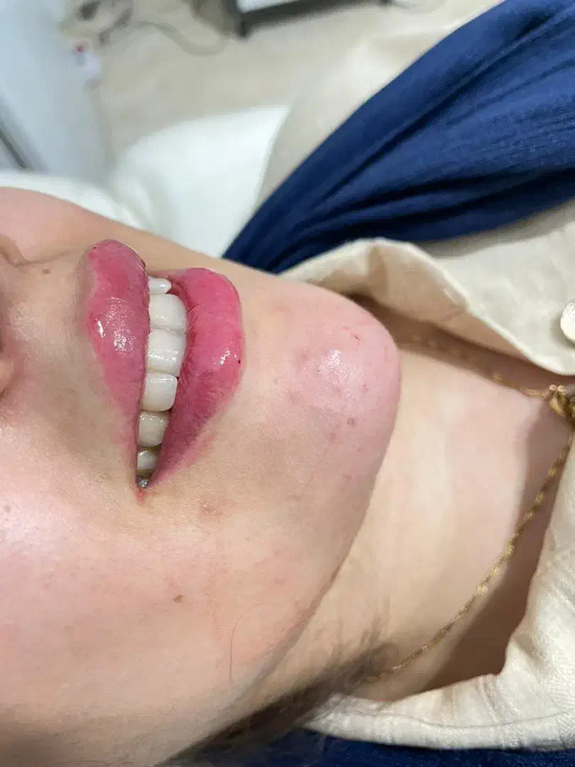 لیزر ژل وبوتاکس وخالبرداری سم زدایی|خدمات آرایشگری و زیبایی|تبریز, |دیوار