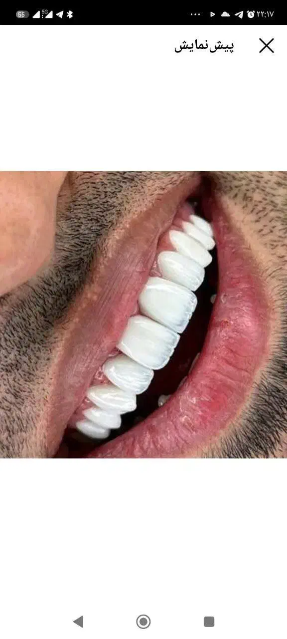 جشنواره کامپوزیت لمینت ، روکش|خدمات آرایشگری و زیبایی|تهران, دردشت|دیوار