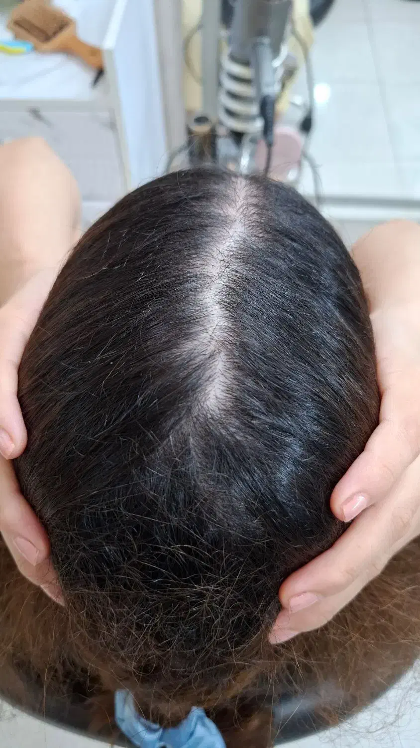 درمان قطعی موخوره و ریزش مو رایگان شد.|خدمات آرایشگری و زیبایی|رشت, کوی بیانی|دیوار