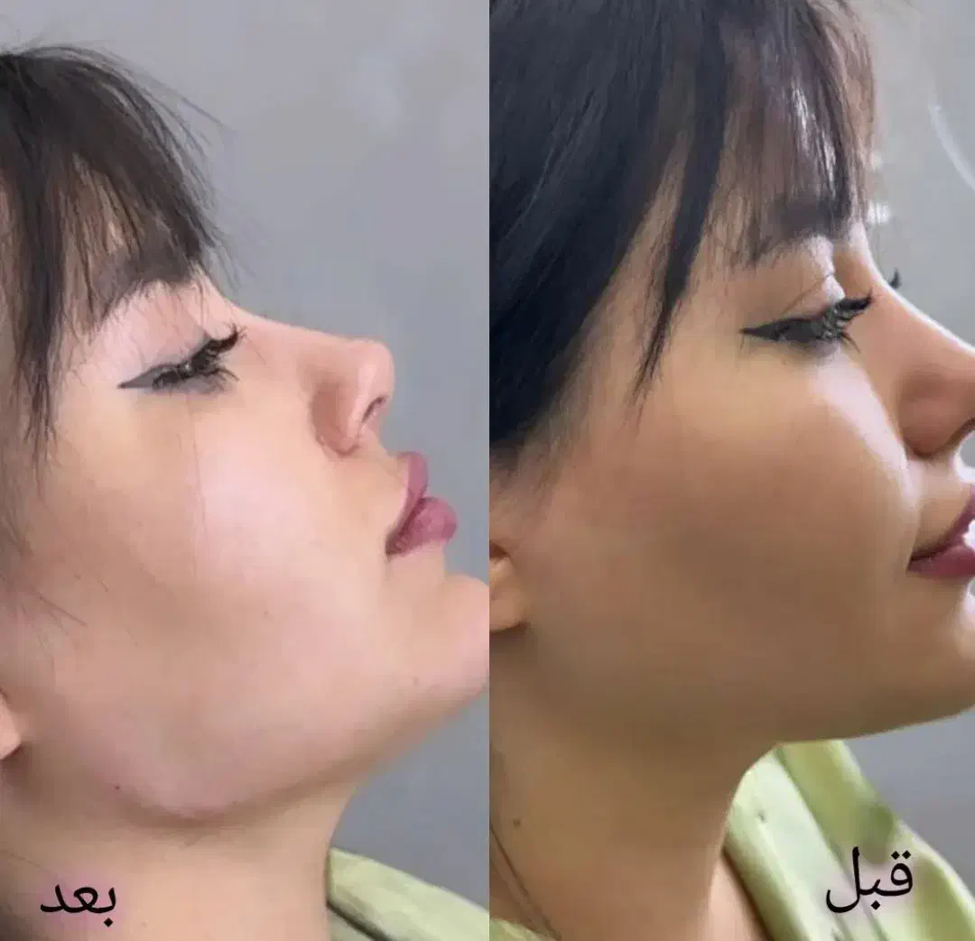 ژل لب.بوتاکس|خدمات آرایشگری و زیبایی|شیراز, شهرک فرزانگان|دیوار