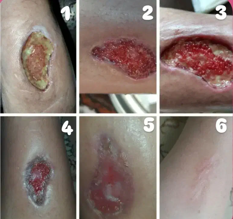 درمان انواع زخم ها با روش های بروز پزشکی|خدمات آرایشگری و زیبایی|تبریز, |دیوار