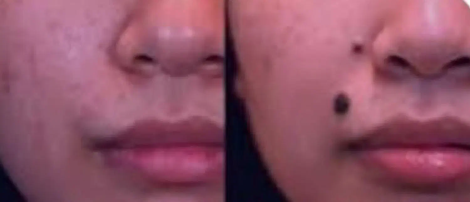 لیزرخال وزگیل منگوله های گوشتی بدون درد|پزشکی|دورود, |دیوار