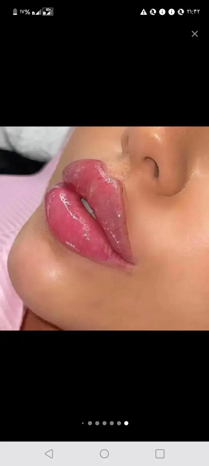 پی آر پی پوست مو و زانو پلاسمای خون PRP|خدمات آرایشگری و زیبایی|قزوین, |دیوار