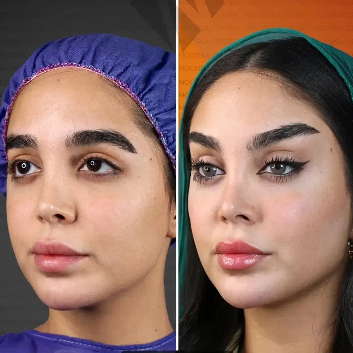 اصلاح فرم بینی بدون عمل Noa آنزیم ژل نخ ابرو غبغب|خدمات زیبایی و سلامت|مشهد, هفت تیر (آب و برق)|دیوار