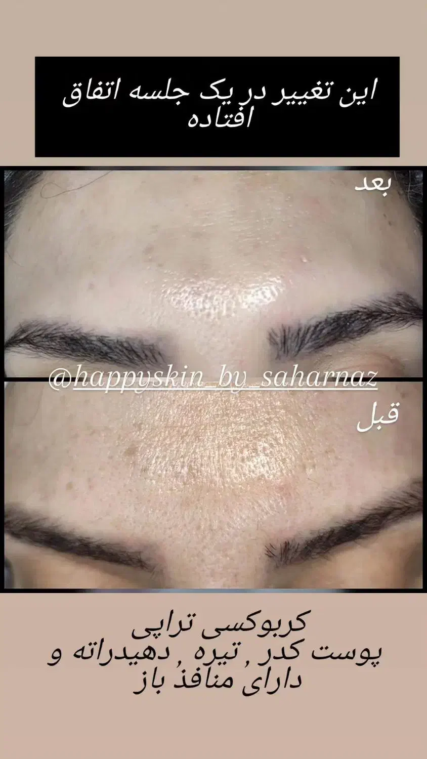 مدل فیشیال وی ای پی و درمان جوش|خدمات آرایشگری و زیبایی|تهران, مجیدیه|دیوار