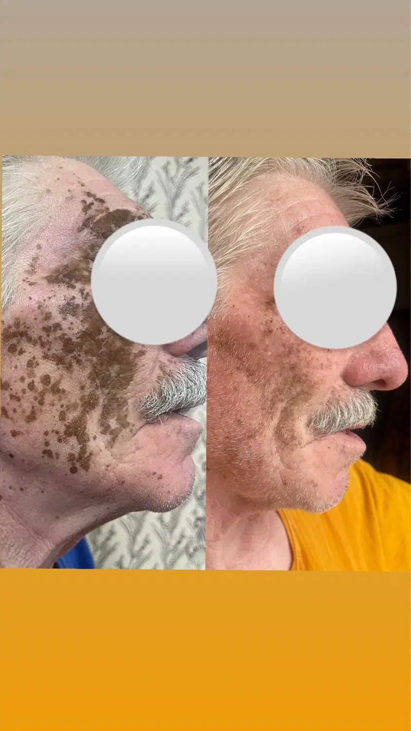 از بین بردن لک و جای جوش فرورفته صورت گچساران|خدمات آرایشگری و زیبایی|دهدشت, |دیوار