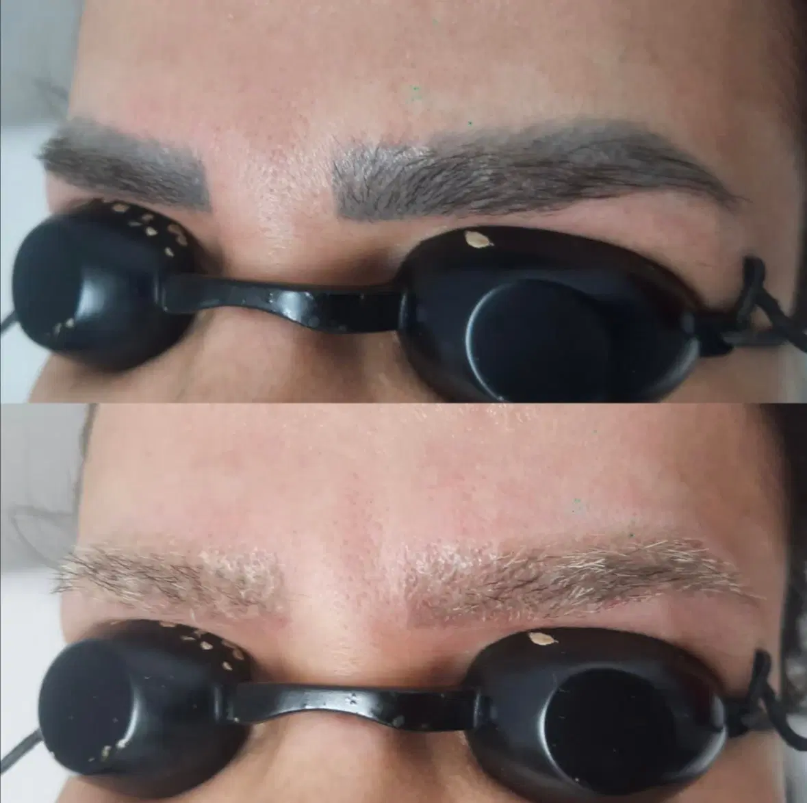 لیزر پاکسازی تتو روشن سازی تخصصی صورت و نواحی تیره|خدمات زیبایی و سلامت|قم, زنبیل آباد|دیوار