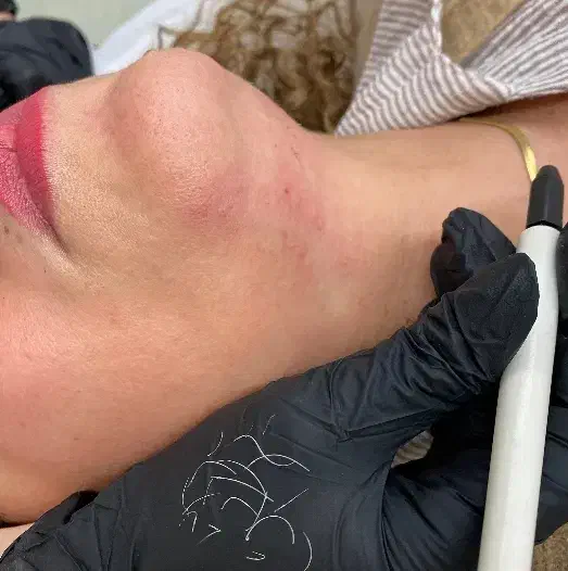 لیزر موهای زائد سفید و سیاه|خدمات آرایشگری و زیبایی|رشت, گلسار|دیوار