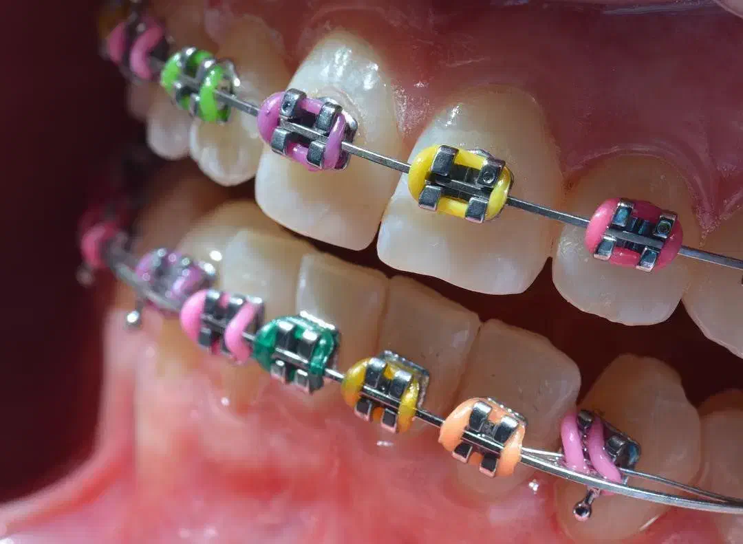 ارتودنسی ثابت و متحرک با اقساط بلند مدت|خدمات آرایشگری و زیبایی|آذرشهر, |دیوار