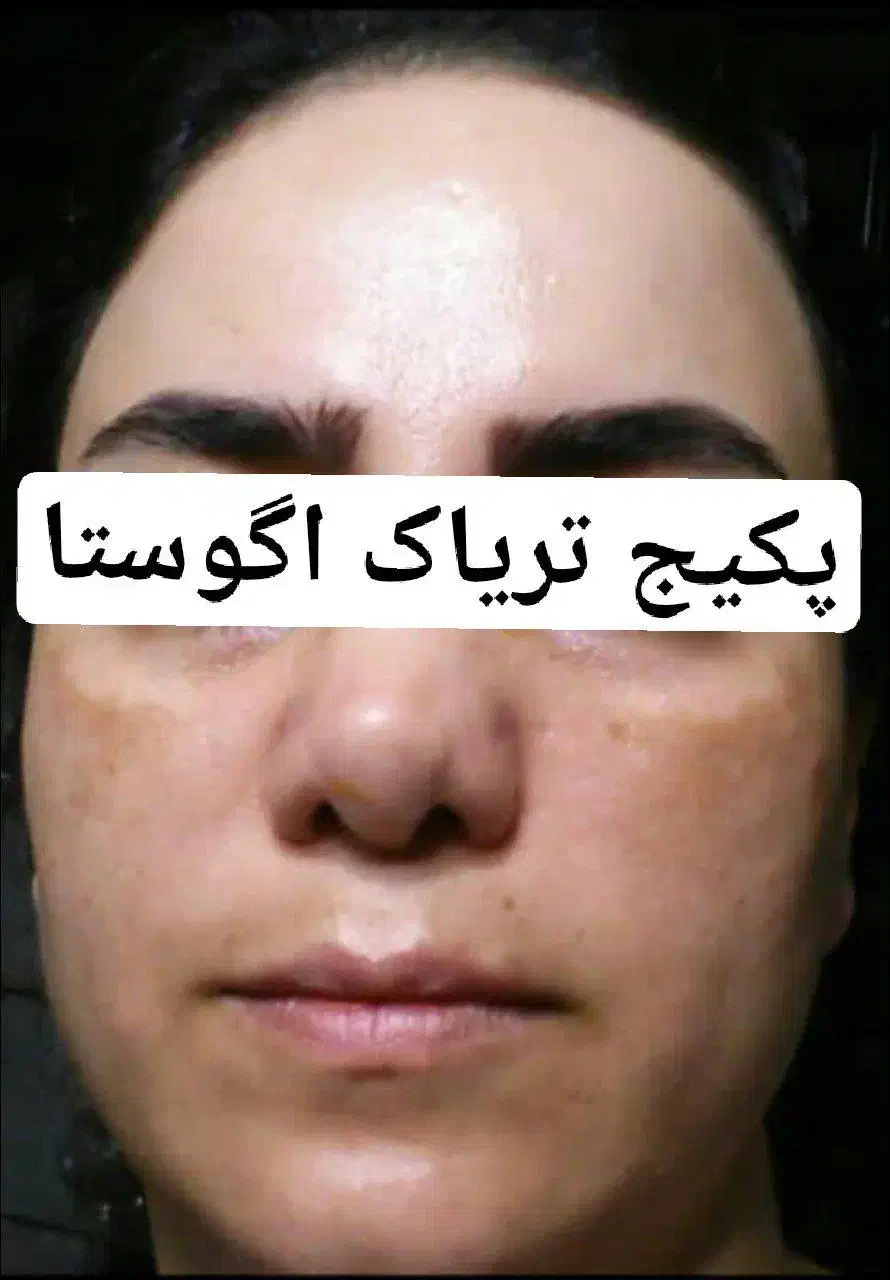 کرم ضدلک تریاک اگوستا|آرایشی، بهداشتی، درمانی|نیشابور, پاستور|دیوار