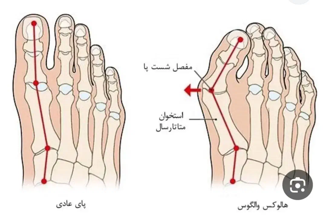 کلینیک تخصصی درمان هالوکس والگوس (شصت پای کج)|خدمات آرایشگری و زیبایی|بهار, |دیوار