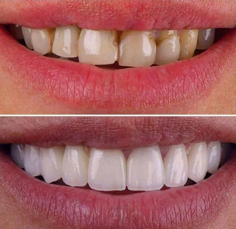 لمینت متحرک دندان|آرایشی، بهداشتی، درمانی|زابل, |دیوار